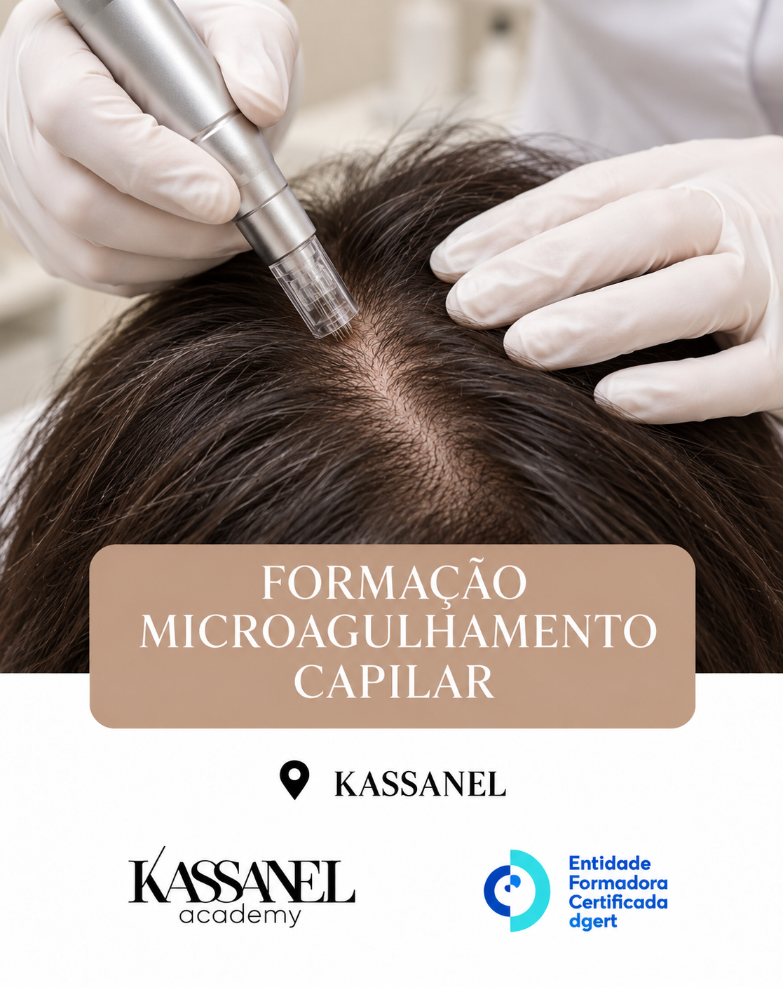 Microagulhamento Capilar